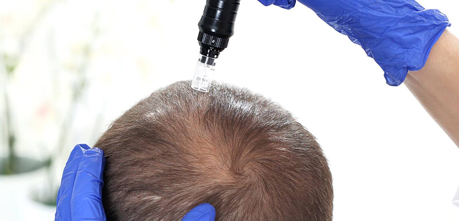 Lekarz medycyny estetycznej wykonuje zabieg mikronakłuwania z mezoterapią igłową mężczyźnie na wypadanie włosów w Błoniu i w Warszawie.