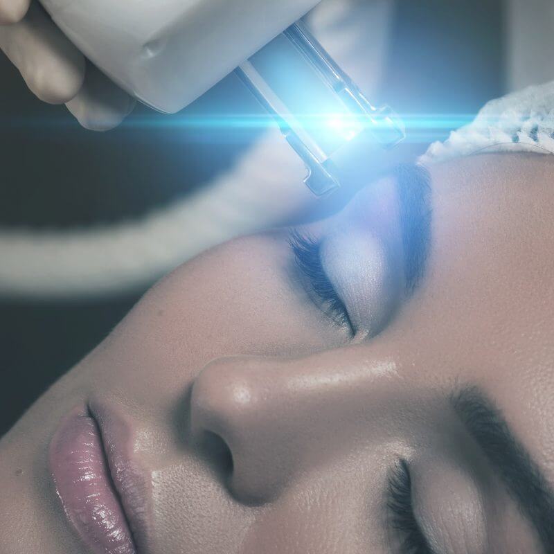 Lekarz medycyny estetycznej wykonuje kobiecie zabieg laser frakcyjny na zmarszczki, rozstępy, blizny i przebarwienia.